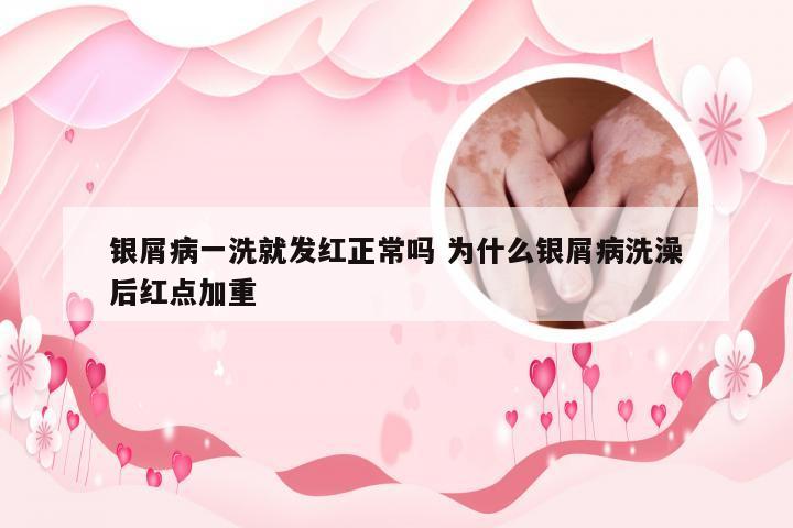 银屑病一洗就发红正常吗 为什么银屑病洗澡后红点加重