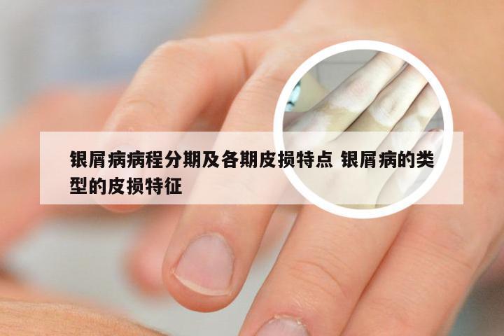 银屑病病程分期及各期皮损特点 银屑病的类型的皮损特征