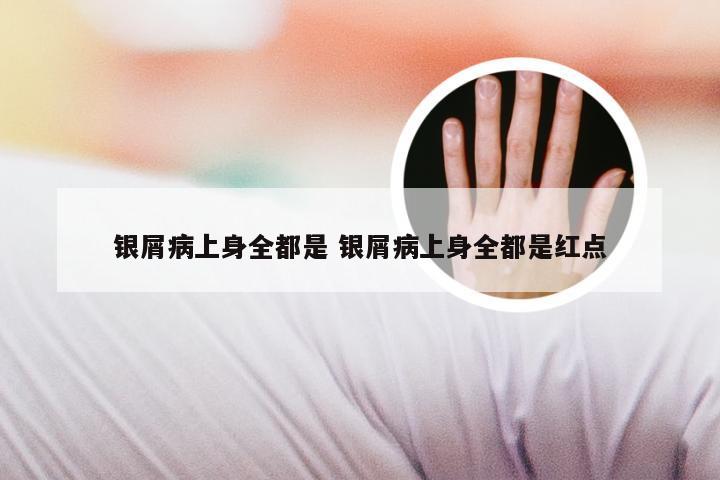 银屑病上身全都是 银屑病上身全都是红点