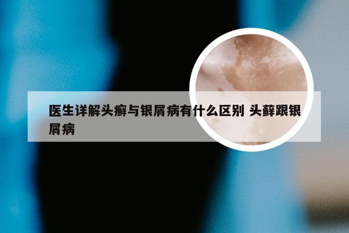 医生详解头癣与银屑病有什么区别 头藓跟银屑病