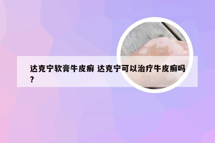 达克宁软膏牛皮癣 达克宁可以治疗牛皮癣吗?