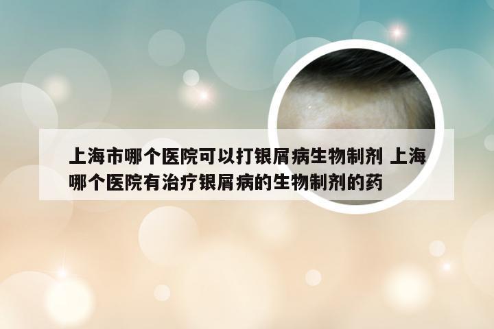 上海市哪个医院可以打银屑病生物制剂 上海哪个医院有治疗银屑病的生物制剂的药