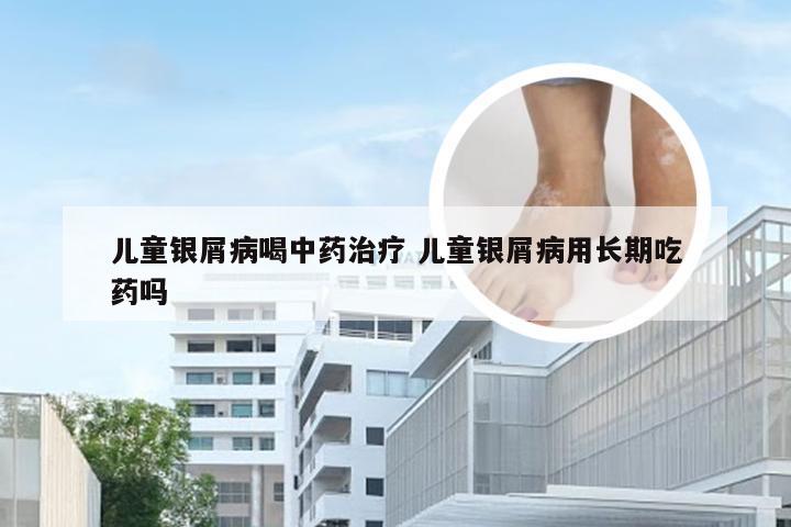 儿童银屑病喝中药治疗 儿童银屑病用长期吃药吗