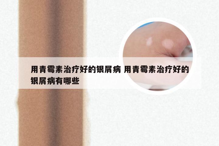 用青霉素治疗好的银屑病 用青霉素治疗好的银屑病有哪些