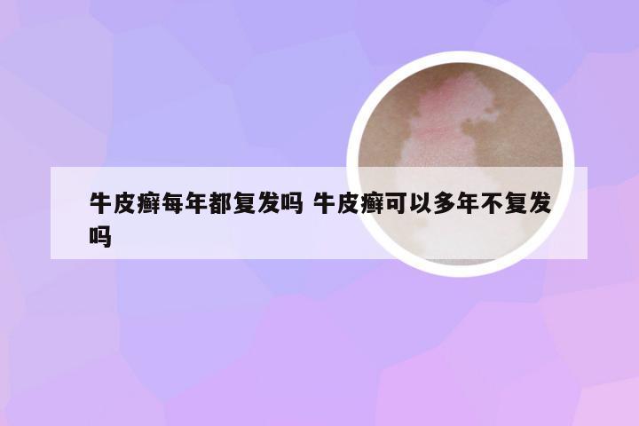 牛皮癣每年都复发吗 牛皮癣可以多年不复发吗