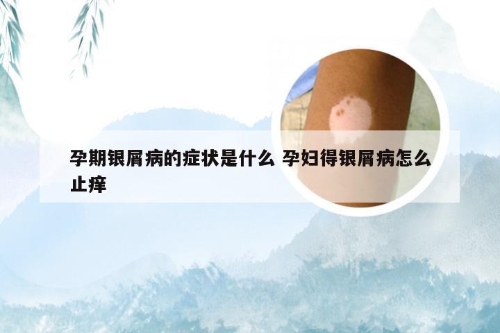 孕期银屑病的症状是什么 孕妇得银屑病怎么止痒