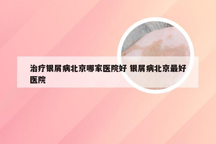 治疗银屑病北京哪家医院好 银屑病北京最好医院