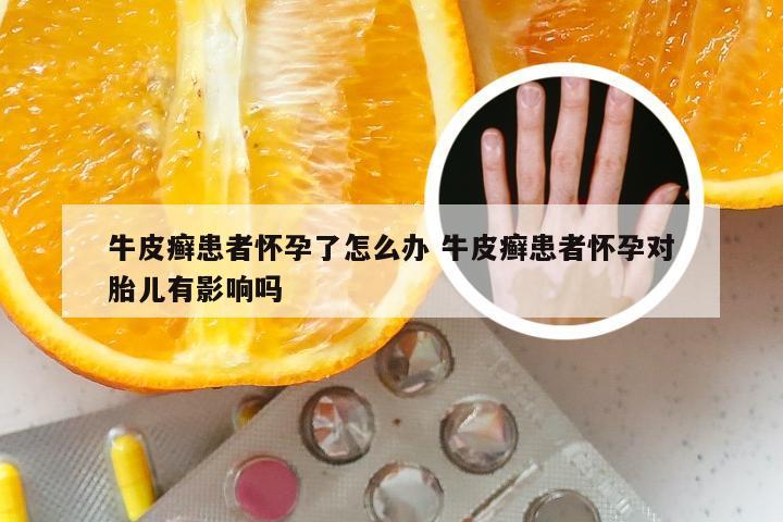 牛皮癣患者怀孕了怎么办 牛皮癣患者怀孕对胎儿有影响吗