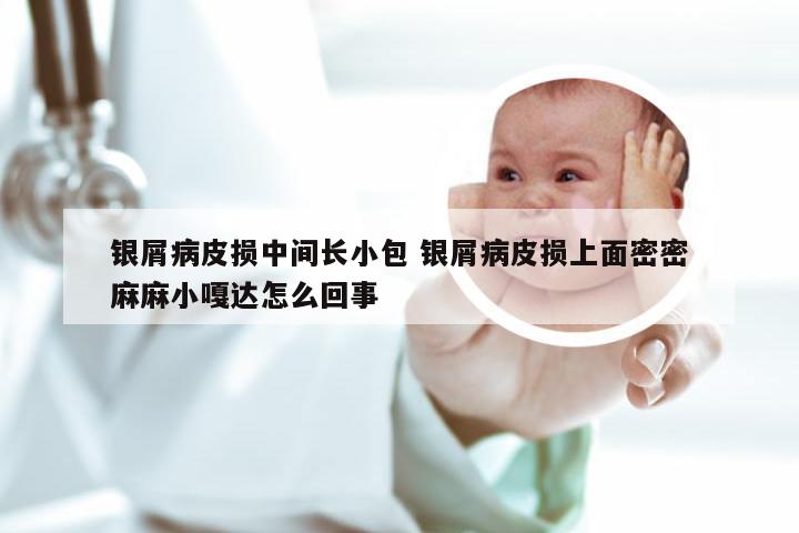 银屑病皮损中间长小包 银屑病皮损上面密密麻麻小嘎达怎么回事