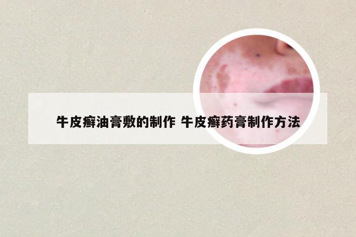 牛皮癣油膏敷的制作 牛皮癣药膏制作方法