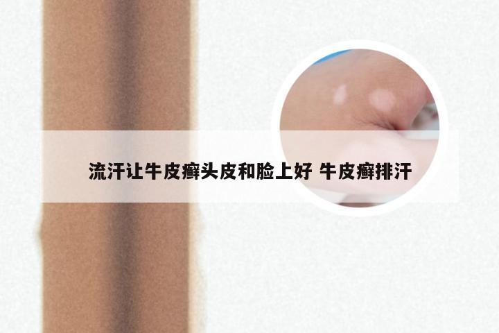 流汗让牛皮癣头皮和脸上好 牛皮癣排汗