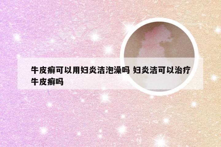 牛皮癣可以用妇炎洁泡澡吗 妇炎洁可以治疗牛皮癣吗