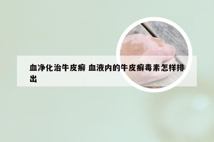 血净化治牛皮癣 血液内的牛皮癣毒素怎样排出