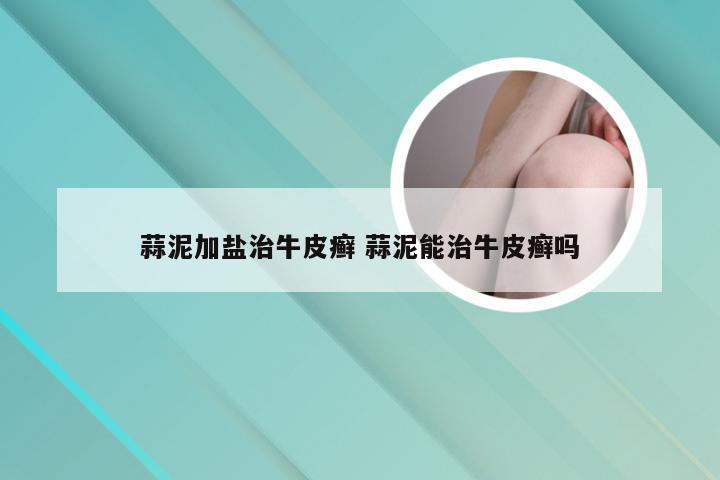 蒜泥加盐治牛皮癣 蒜泥能治牛皮癣吗