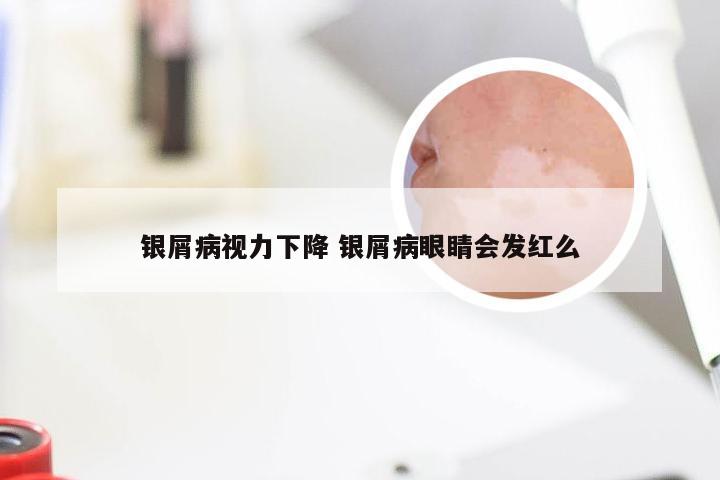 银屑病视力下降 银屑病眼睛会发红么