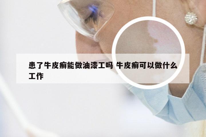 患了牛皮癣能做油漆工吗 牛皮癣可以做什么工作