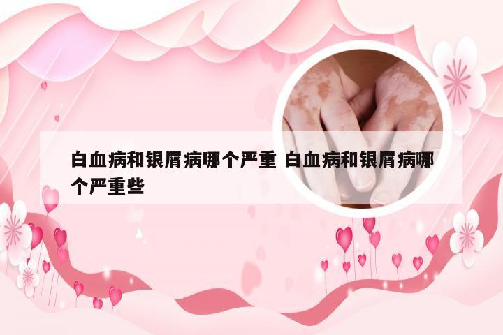 白血病和银屑病哪个严重 白血病和银屑病哪个严重些