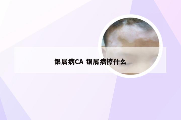 银屑病CA 银屑病擦什么
