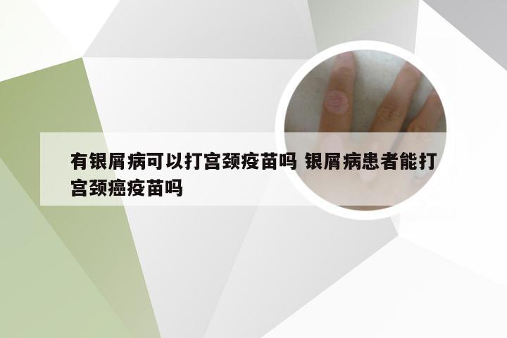 有银屑病可以打宫颈疫苗吗 银屑病患者能打宫颈癌疫苗吗