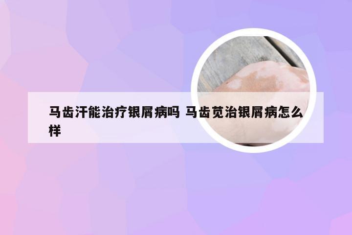 马齿汗能治疗银屑病吗 马齿苋治银屑病怎么样