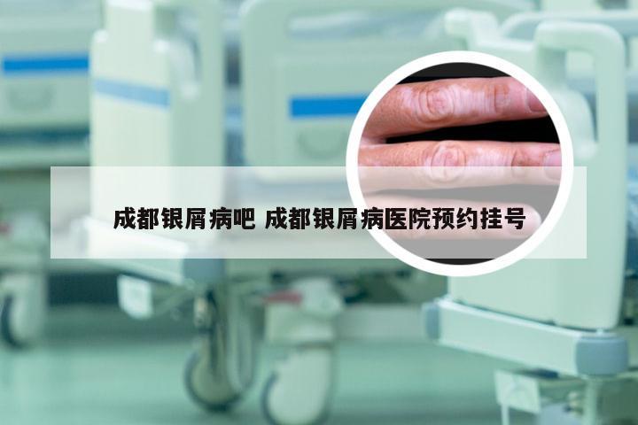 成都银屑病吧 成都银屑病医院预约挂号