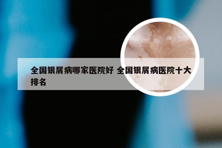 全国银屑病哪家医院好 全国银屑病医院十大排名
