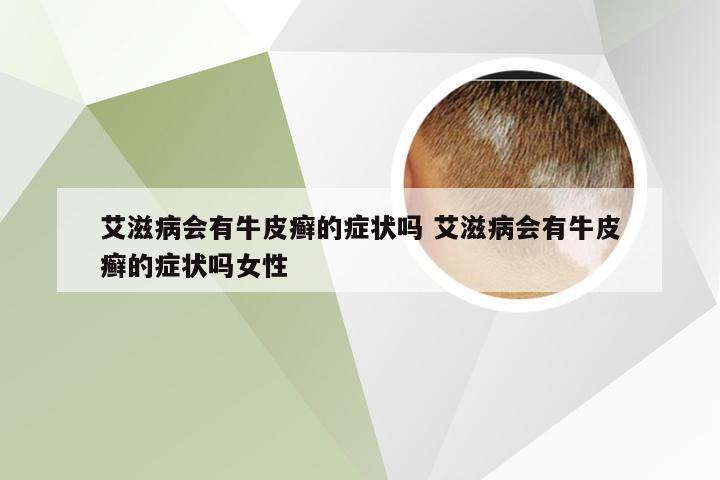 艾滋病会有牛皮癣的症状吗 艾滋病会有牛皮癣的症状吗女性