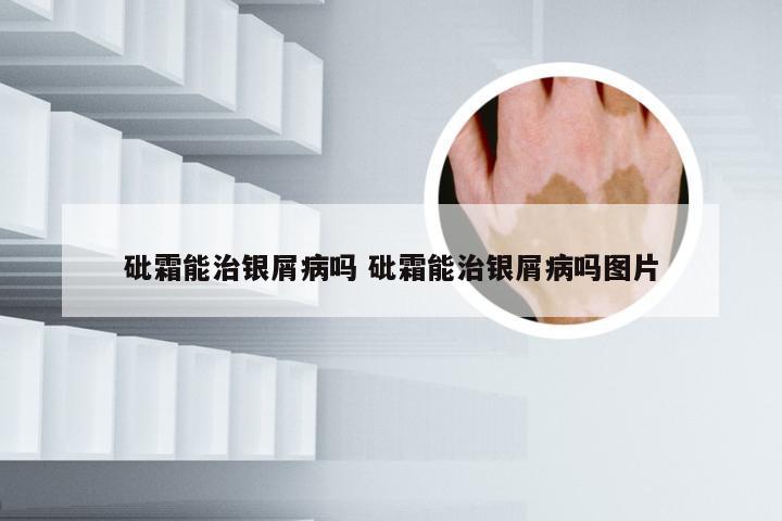 砒霜能治银屑病吗 砒霜能治银屑病吗图片