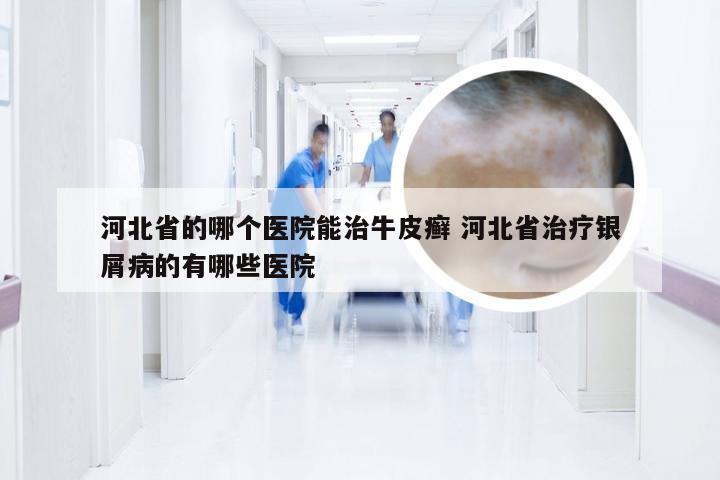 河北省的哪个医院能治牛皮癣 河北省治疗银屑病的有哪些医院