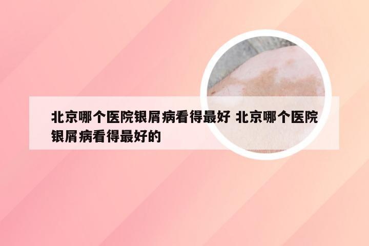 北京哪个医院银屑病看得最好 北京哪个医院银屑病看得最好的