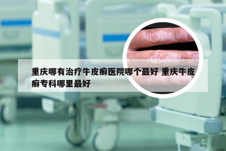 重庆哪有治疗牛皮癣医院哪个最好 重庆牛皮癣专科哪里最好