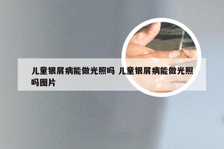 儿童银屑病能做光照吗 儿童银屑病能做光照吗图片