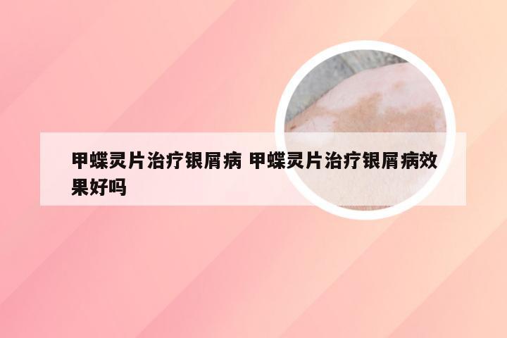甲蝶灵片治疗银屑病 甲蝶灵片治疗银屑病效果好吗