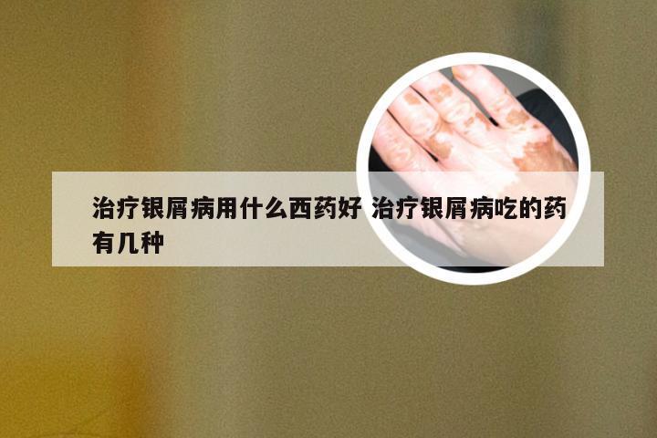 治疗银屑病用什么西药好 治疗银屑病吃的药有几种