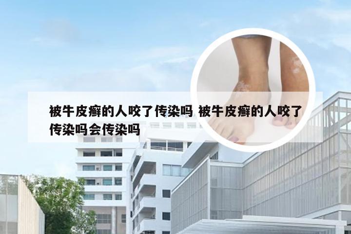 被牛皮癣的人咬了传染吗 被牛皮癣的人咬了传染吗会传染吗