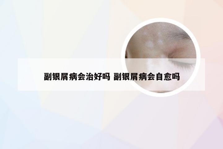 副银屑病会治好吗 副银屑病会自愈吗