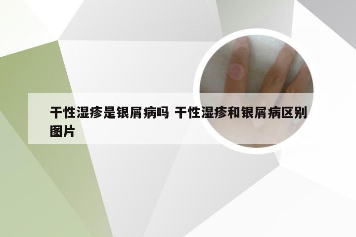 干性湿疹是银屑病吗 干性湿疹和银屑病区别图片