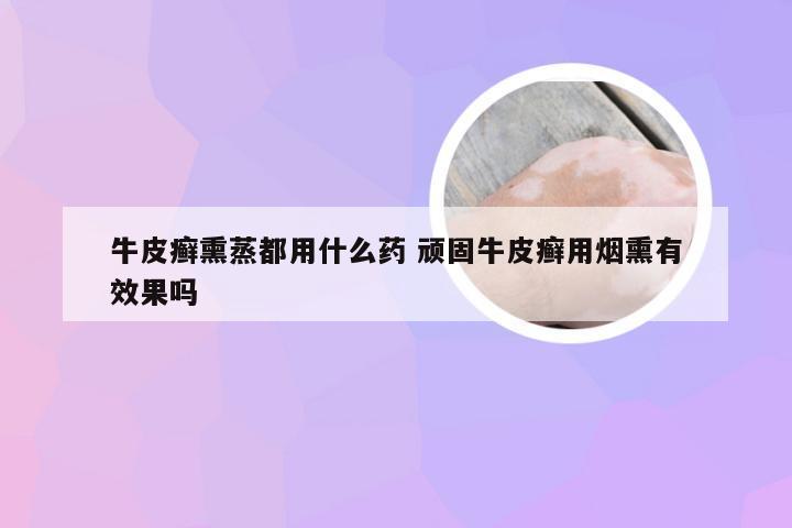 牛皮癣熏蒸都用什么药 顽固牛皮癣用烟熏有效果吗