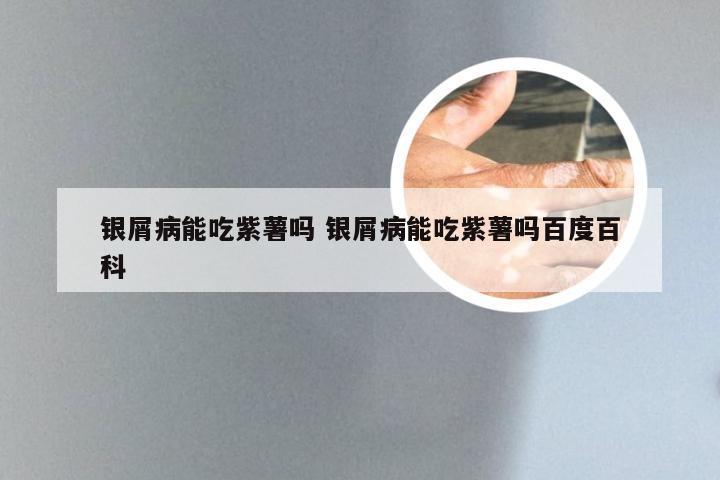 银屑病能吃紫薯吗 银屑病能吃紫薯吗百度百科