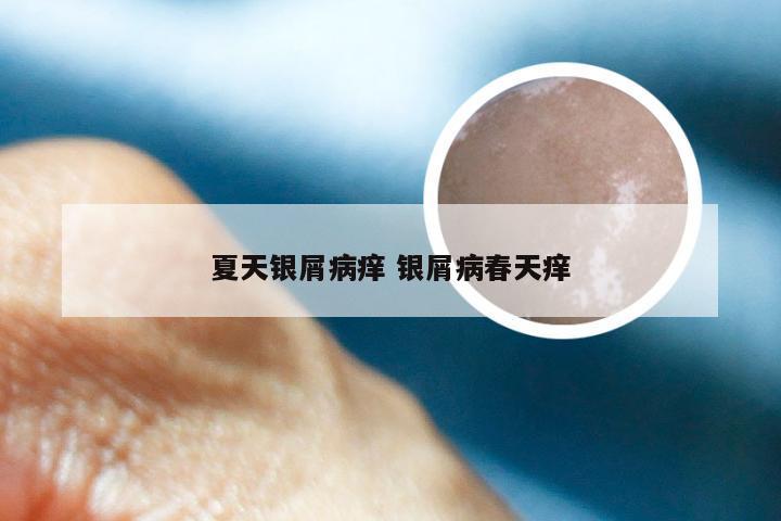 夏天银屑病痒 银屑病春天痒