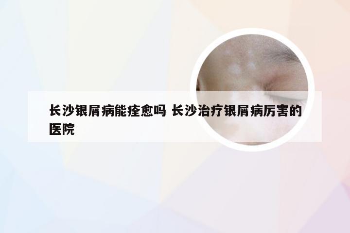 长沙银屑病能痊愈吗 长沙治疗银屑病厉害的医院