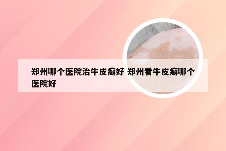 郑州哪个医院治牛皮癣好 郑州看牛皮癣哪个医院好