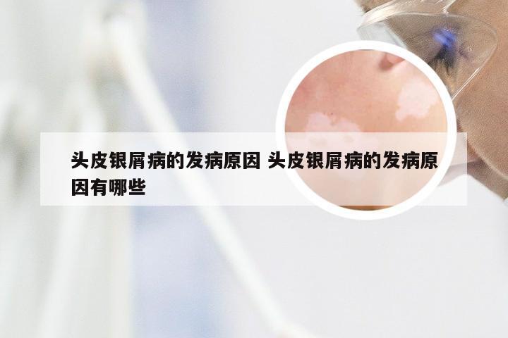 头皮银屑病的发病原因 头皮银屑病的发病原因有哪些