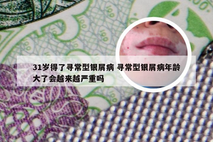 31岁得了寻常型银屑病 寻常型银屑病年龄大了会越来越严重吗