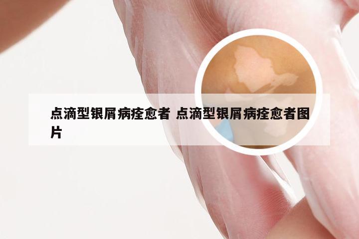 点滴型银屑病痊愈者 点滴型银屑病痊愈者图片