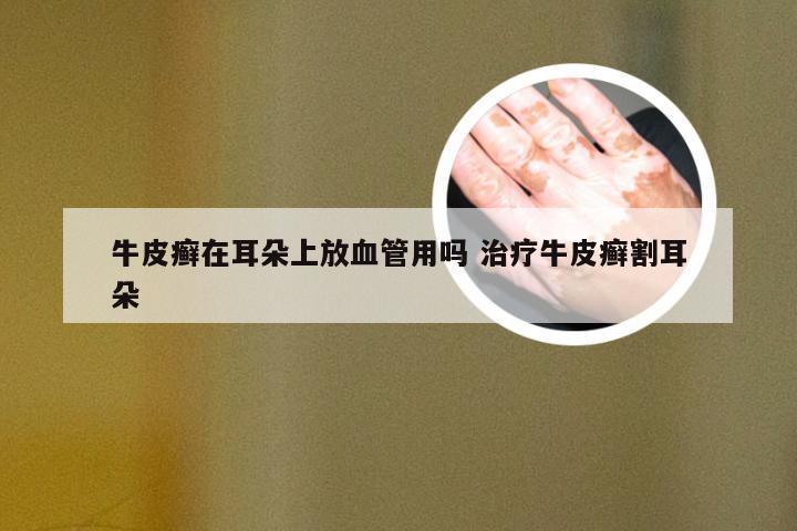 牛皮癣在耳朵上放血管用吗 治疗牛皮癣割耳朵