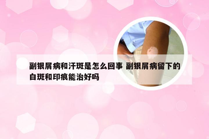 副银屑病和汗斑是怎么回事 副银屑病留下的白斑和印痕能治好吗
