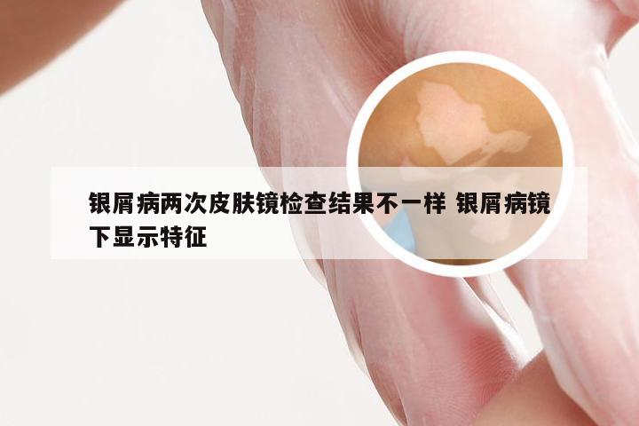 银屑病两次皮肤镜检查结果不一样 银屑病镜下显示特征