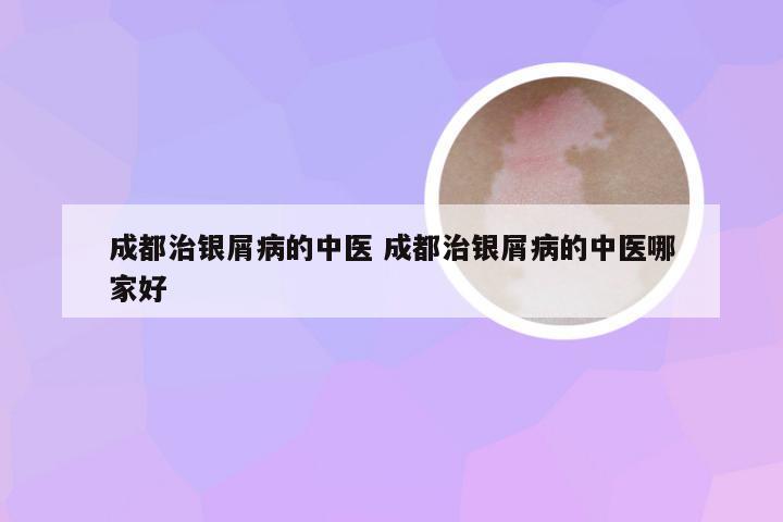 成都治银屑病的中医 成都治银屑病的中医哪家好