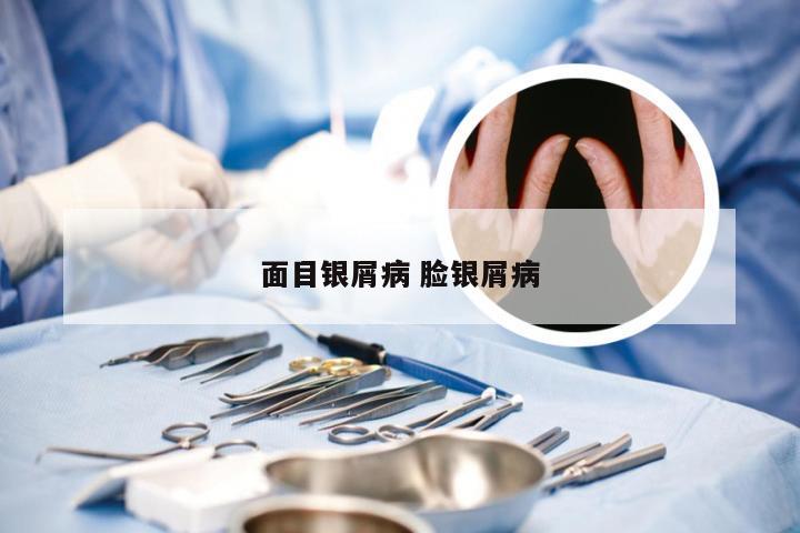 面目银屑病 脸银屑病